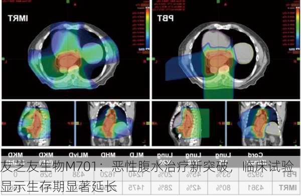 友芝友生物M701：恶性腹水治疗新突破，临床试验显示生存期显著延长