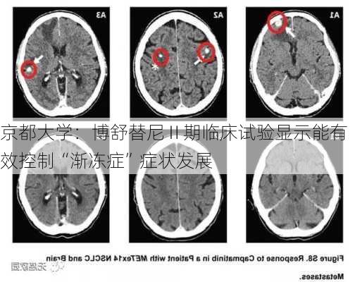 京都大学：博舒替尼Ⅱ期临床试验显示能有效控制“渐冻症”症状发展