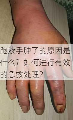 跑液手肿了的原因是什么？如何进行有效的急救处理？